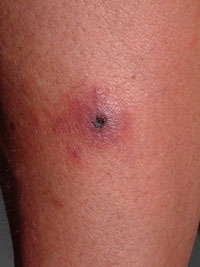 Rash